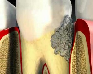 Стоматология: причины образования зубного камня и пародонтита?