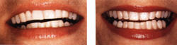 Исправление внешнего вида зубов с помощью косметического контурирования. Слева - до, спрва - после.