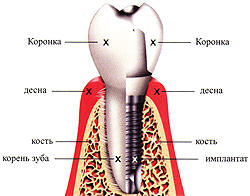 Имплантация зубов Пермь