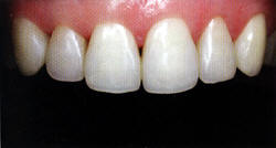 Исправление внешнего вида 4-х зубов с помощью прямой реставрации светокомпозиционным материалом. Вверху - до, внизу - после.