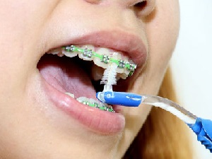 Гигиена зубов с брекет-системой