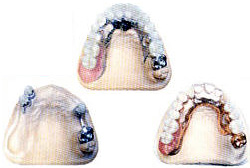 Протезирование зубов, протезирование зубов цены в Перми.