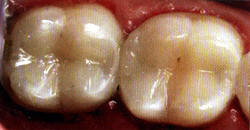 Лечение боковых зубов с реставрацией их светокомпозиционным материалом. Сверу - до, внизу - после.